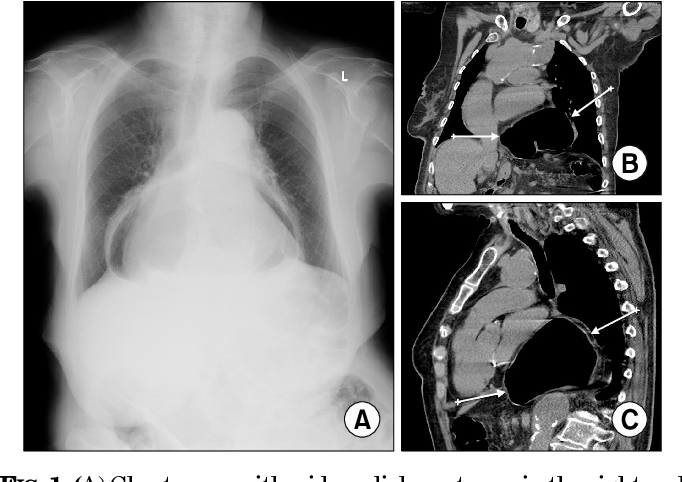 Figure 1 from Hiatal Hernia Mistaken for Oesophageal Perforation after ...