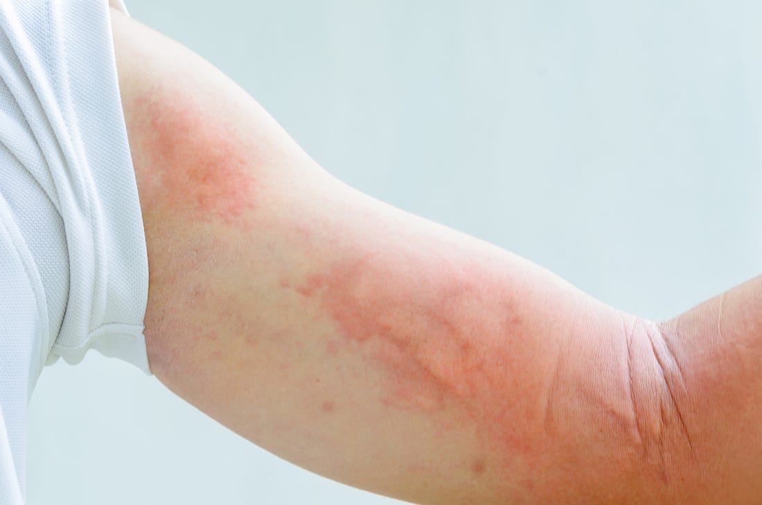 Rash on Arm Causes: Itchy, Red, Treatments, and Remedies - American Celiac