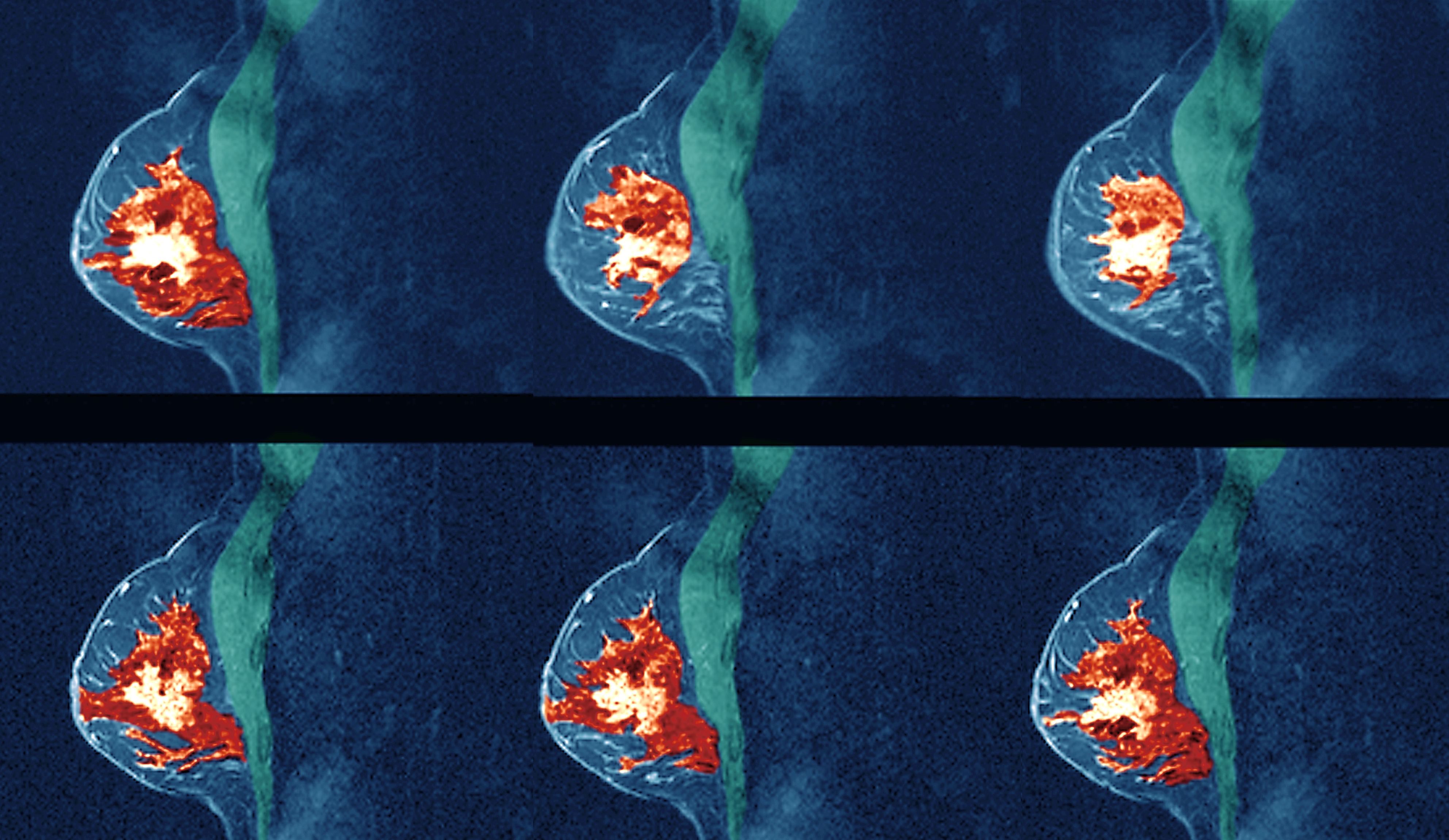 Benefits Of Mri With Contrast