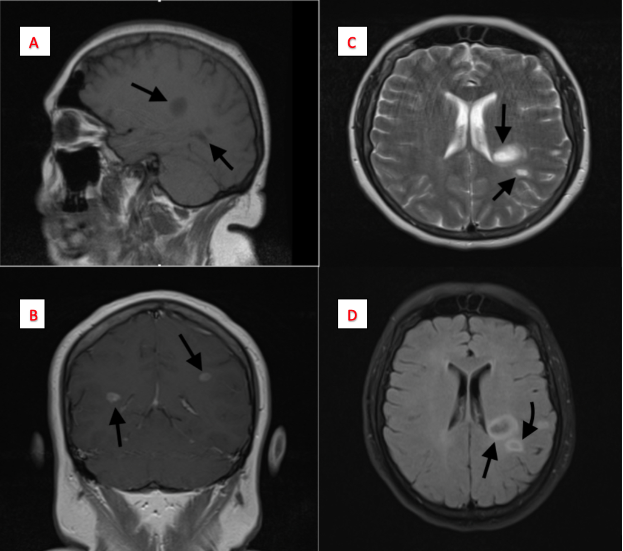 Cureus Tumefactive Multiple Sclerosis A Rare Variant | Free Nude Porn ...