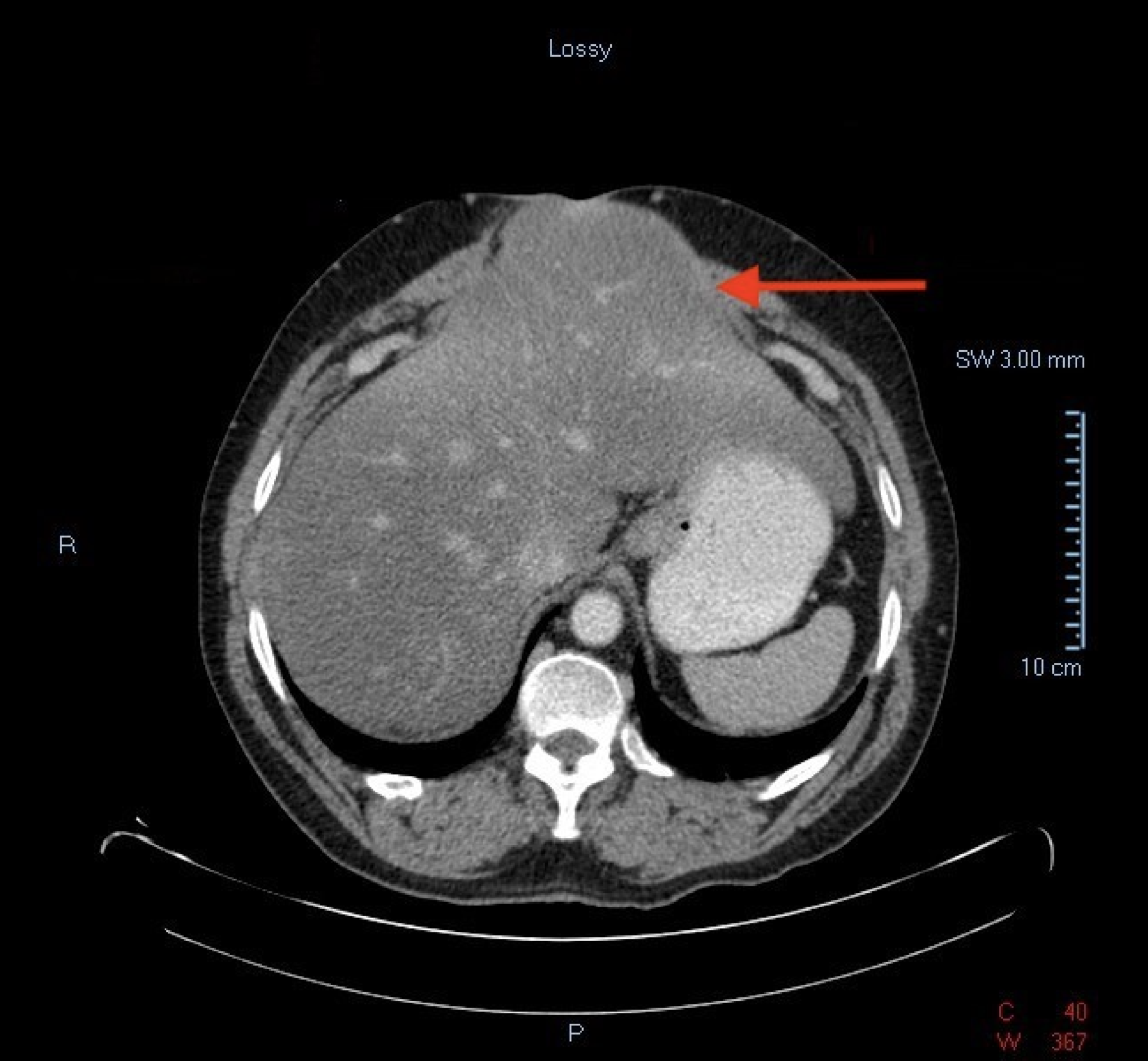 Ct Scan For Hernia Cost Ct Scan Machine Images