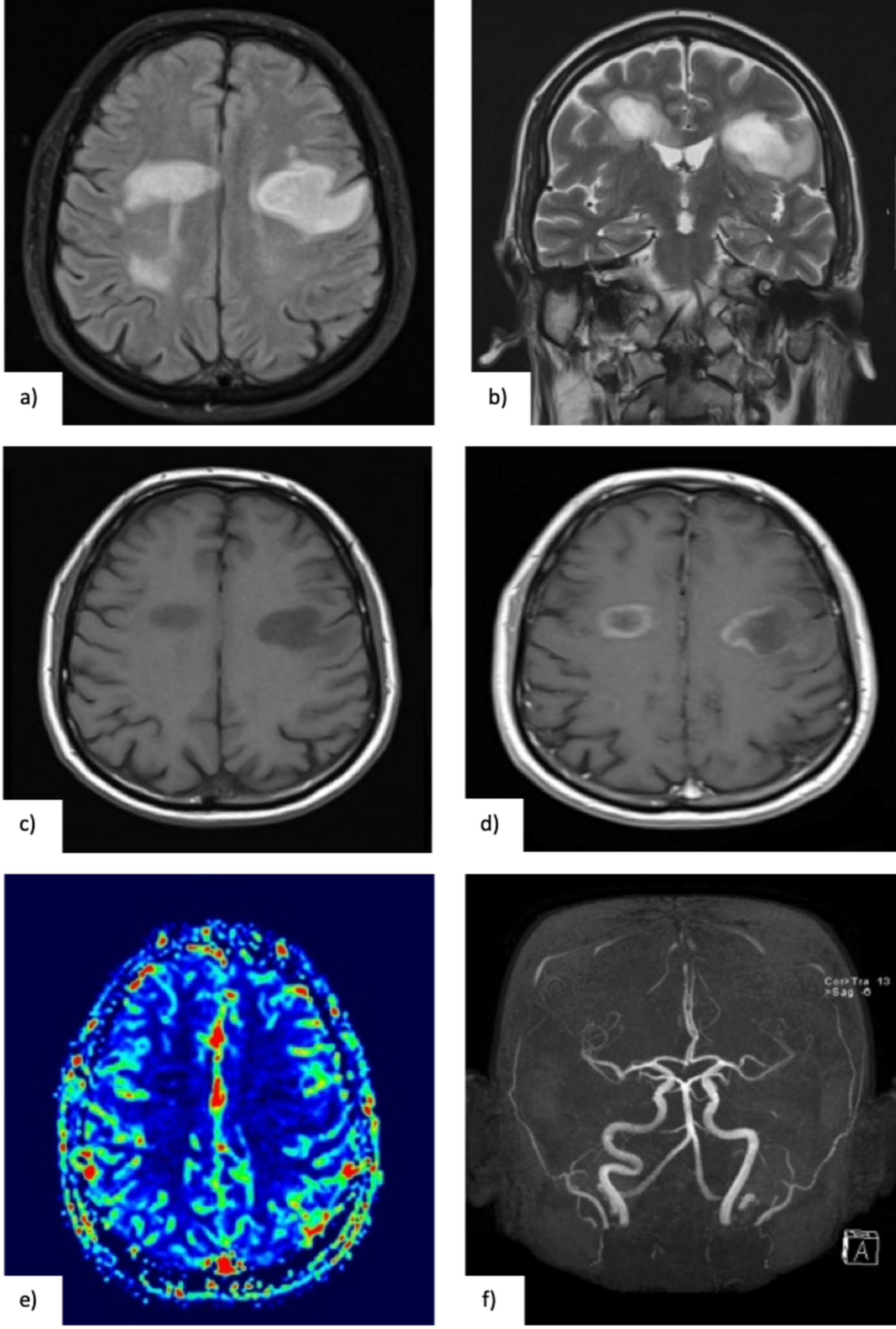 White Matter Lesions On Cerebral Mri Cerebral Mri Of Two Women ...