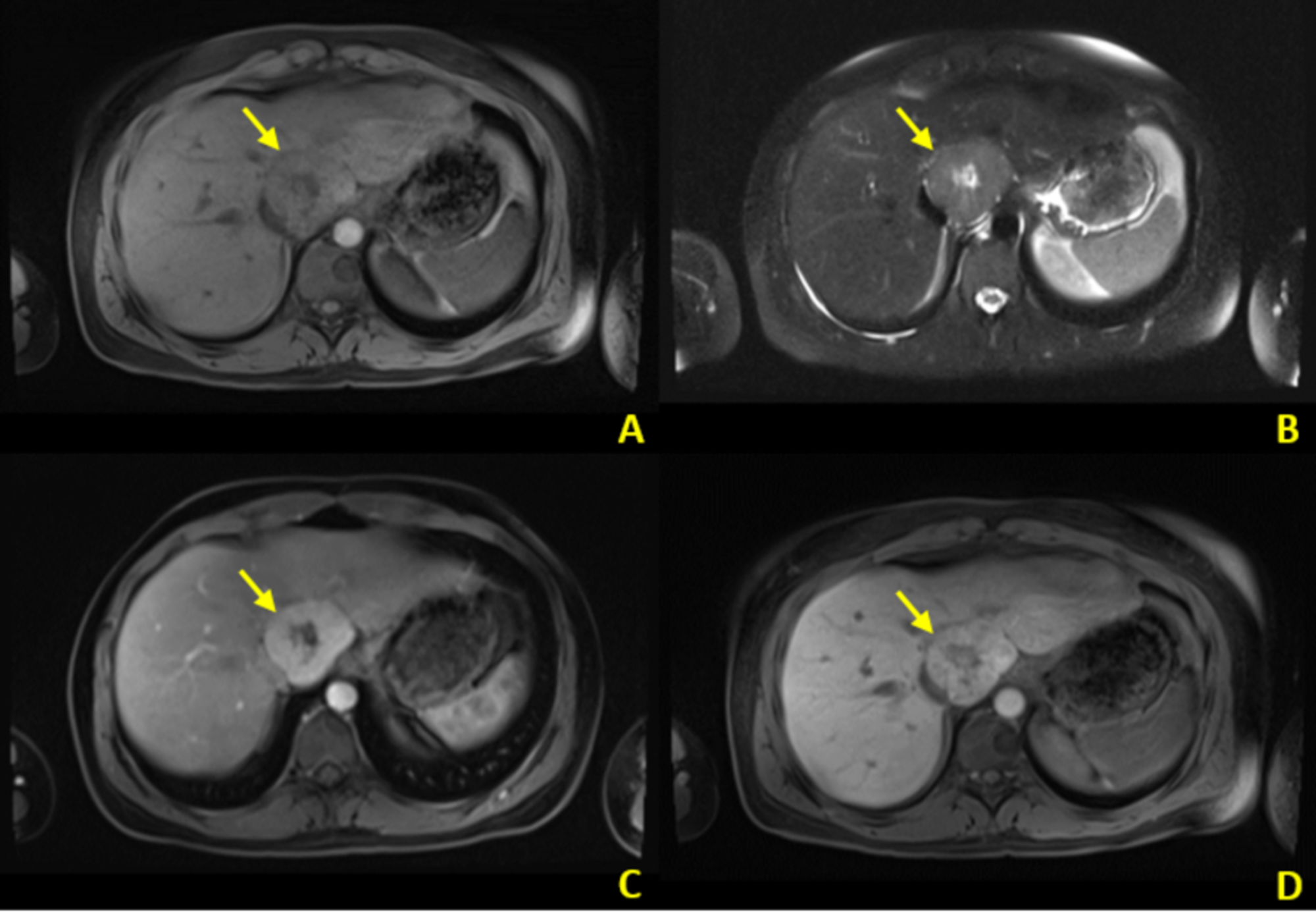 Their Imaging Characteristics A Review of Benign Hepatic ... › articles ...