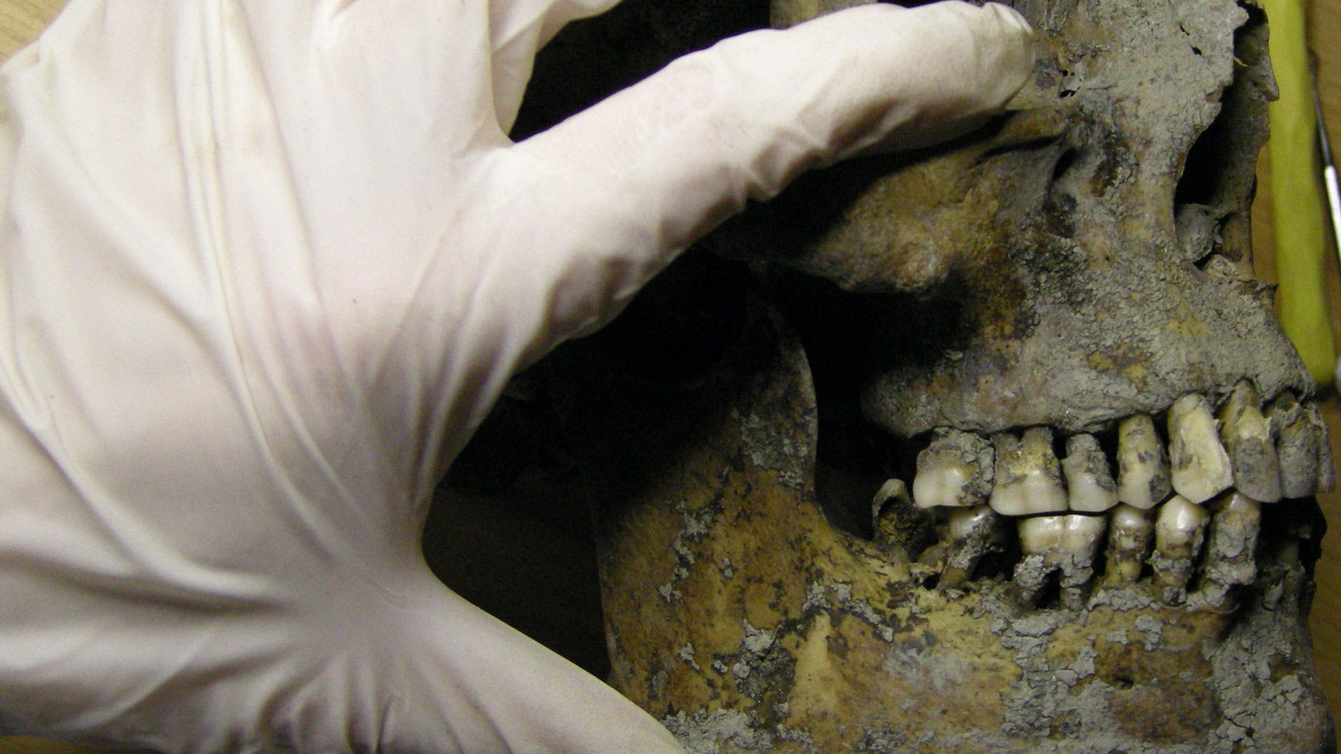Examination of Viking jaw and teeth.