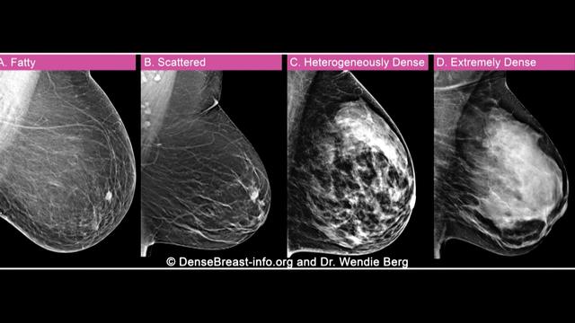 A chart showing the difference between fatty, scattered, heterogeneously dense and extremely dense breasts. 