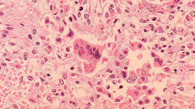 measles-getty.jpg 