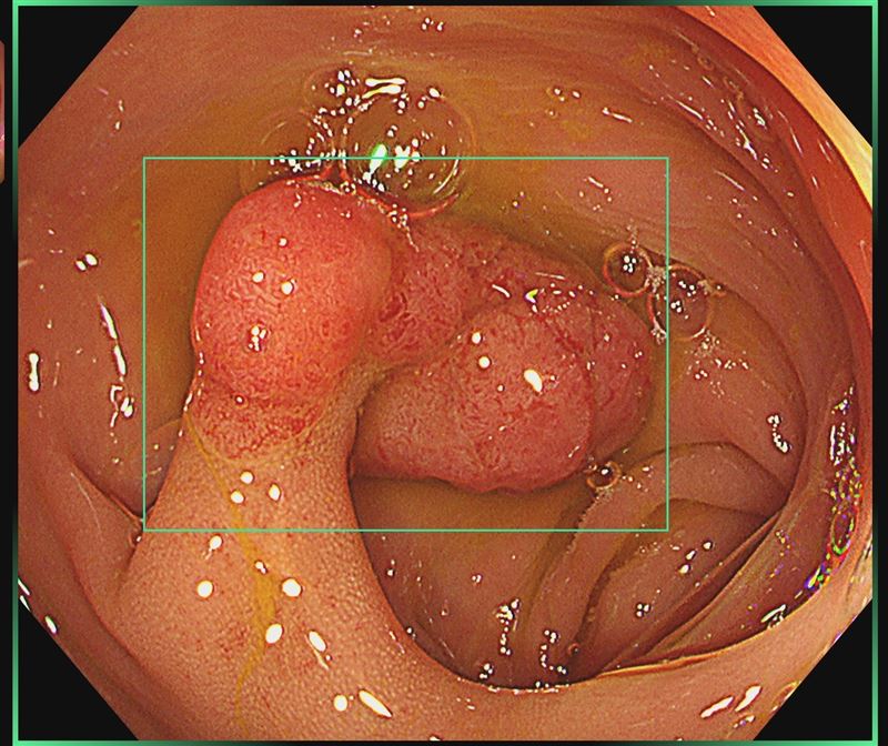 擁有做過5、6萬次大腸鏡經驗的肝膽腸胃科醫師葉秉威，根據自己歸納統計出6種容易有大腸腺瘤者。(圖／胃腸專家 葉秉威醫師)