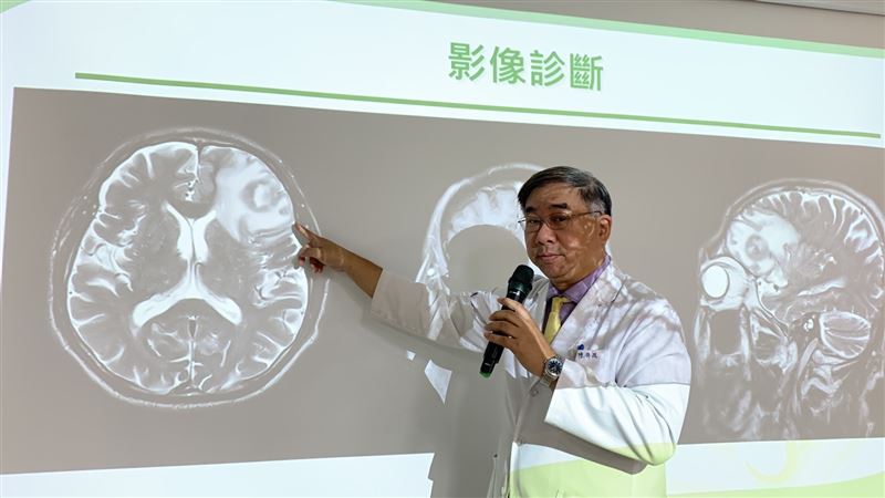 健談男變沉默哥！以為中風竟罹「腦瘤」