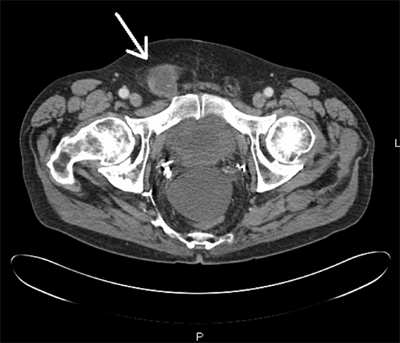 Inguinal Hernia Ct Scan