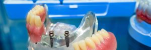 livonia mini implants