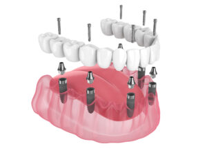 livonia dental implant dentures