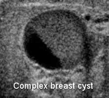 Enlarging Breast Cyst Factory Sale | centralcountiesservices.org