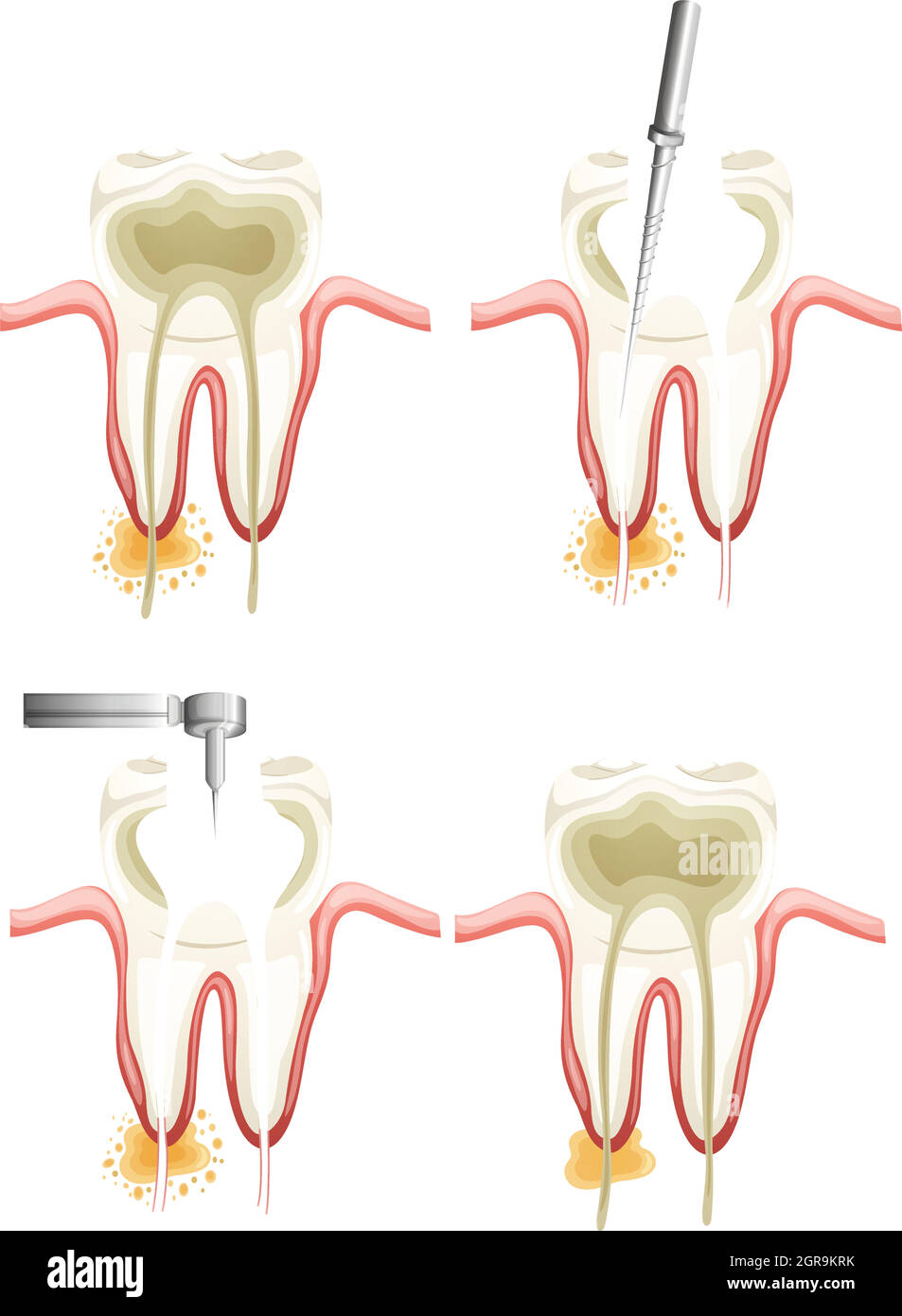 Root canal procedure Stock Vector