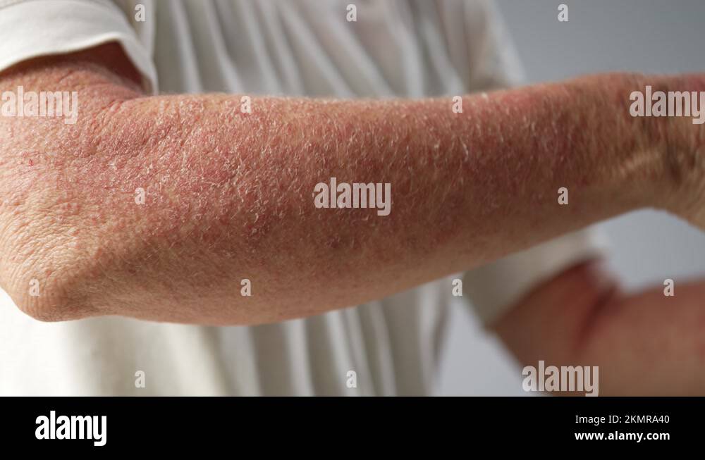 Extreme closeup of woman showing dry scaly skin rash hives on her arm ...