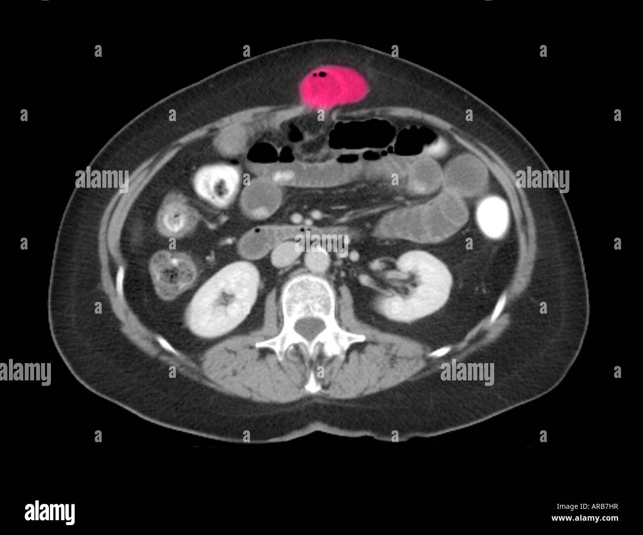 Ct Scan Sagittal View Showing An Abdominal Wall Hernia Stock Photo ...