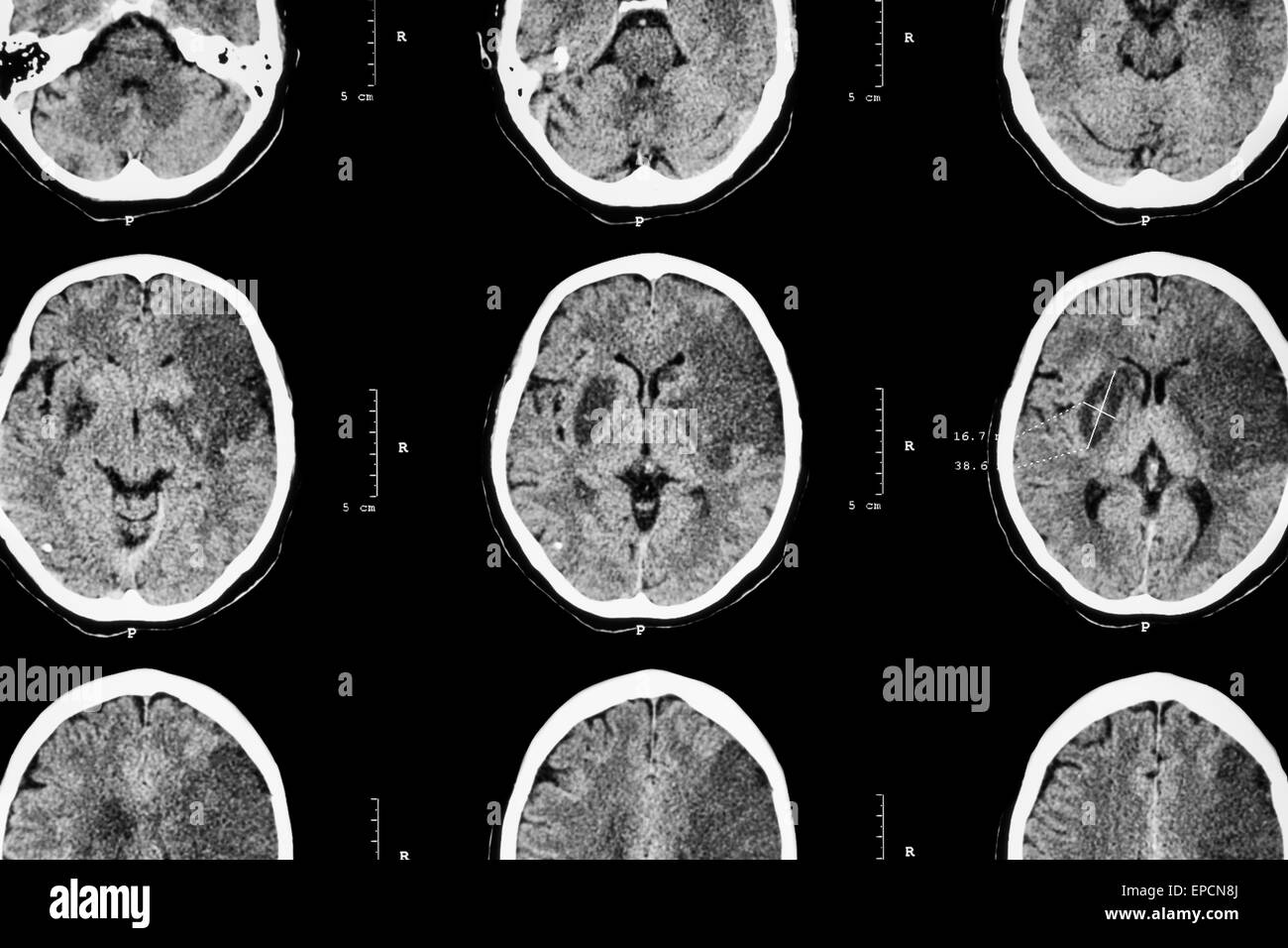 Ischemic stroke : ( CT of brain show cerebral infarction at left frontal - temporal - parietal lobe ) ( nervous system backgroun Stock Photo