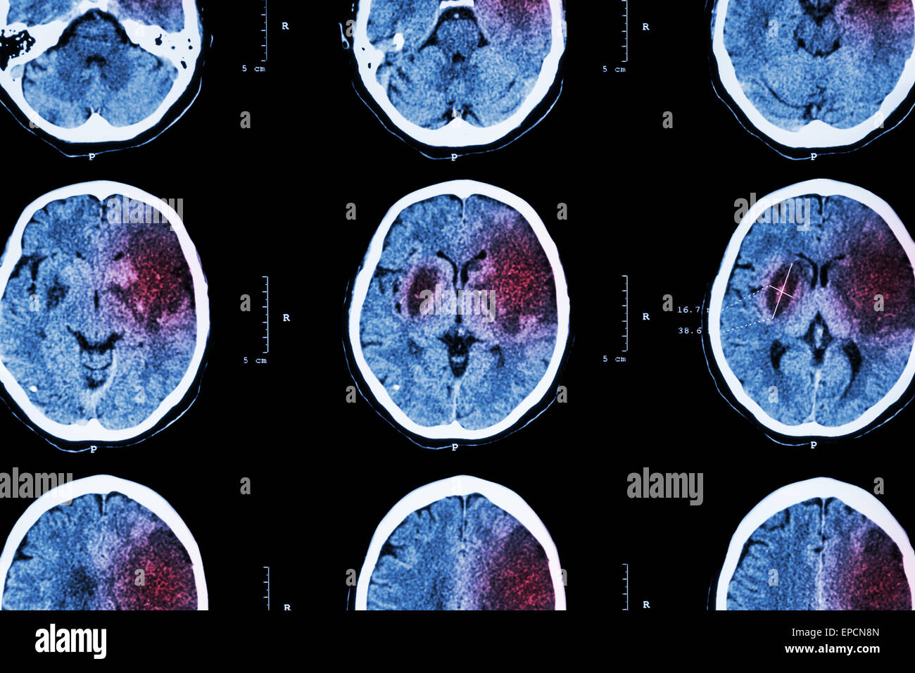 Ischemic stroke : ( CT of brain show cerebral infarction at left frontal - temporal - parietal lobe ) ( nervous system backgroun Stock Photo