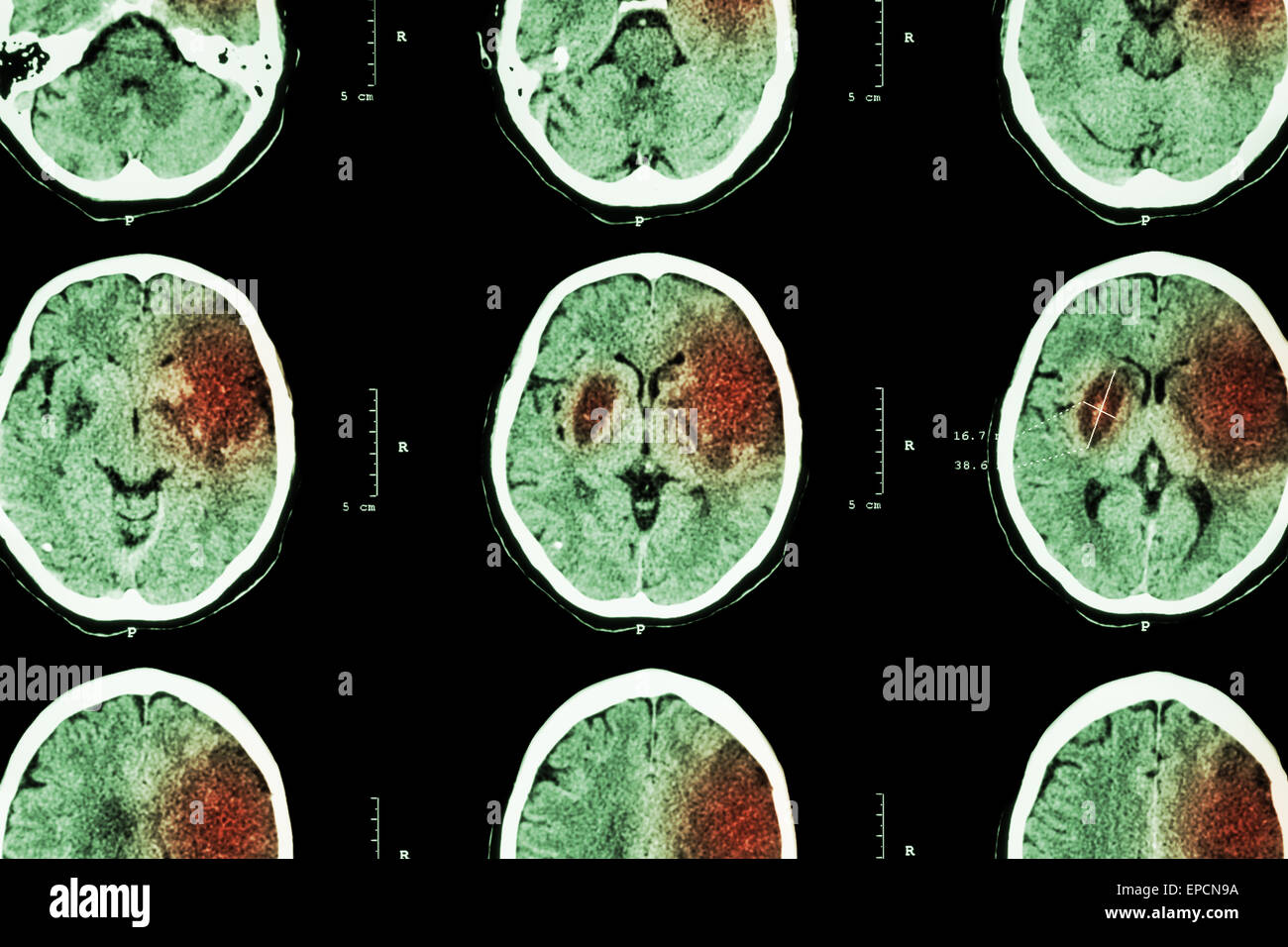 Ischemic stroke : ( CT of brain show cerebral infarction at left frontal - temporal - parietal lobe ) ( nervous system backgroun Stock Photo