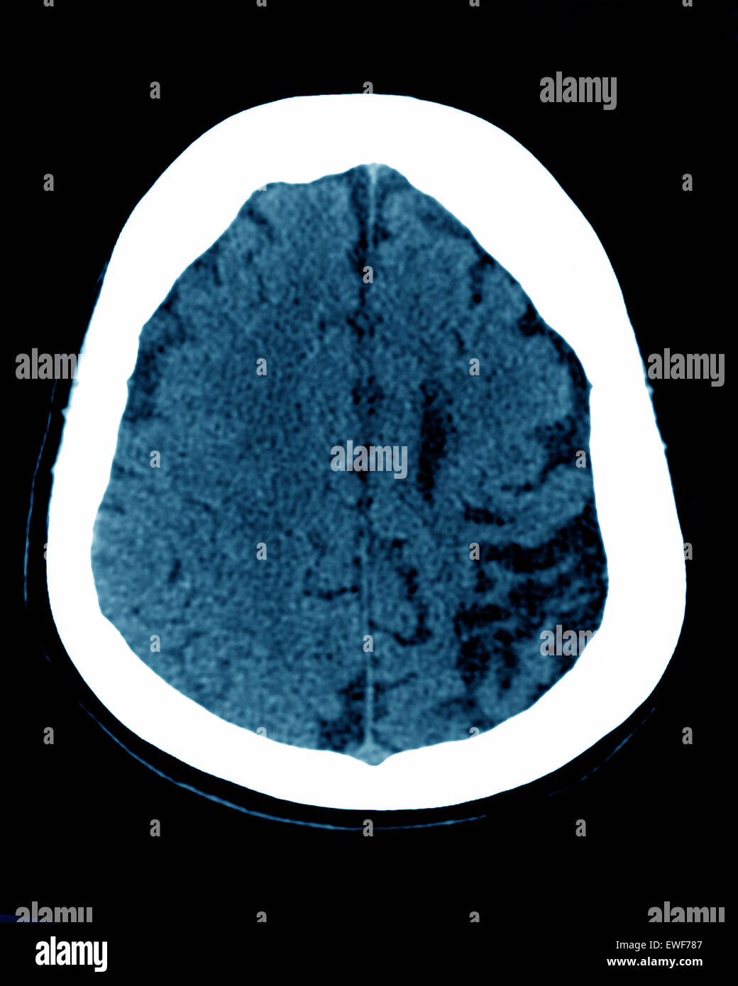 CEREBRAL ATROPHY, CT-SCAN Stock Photo