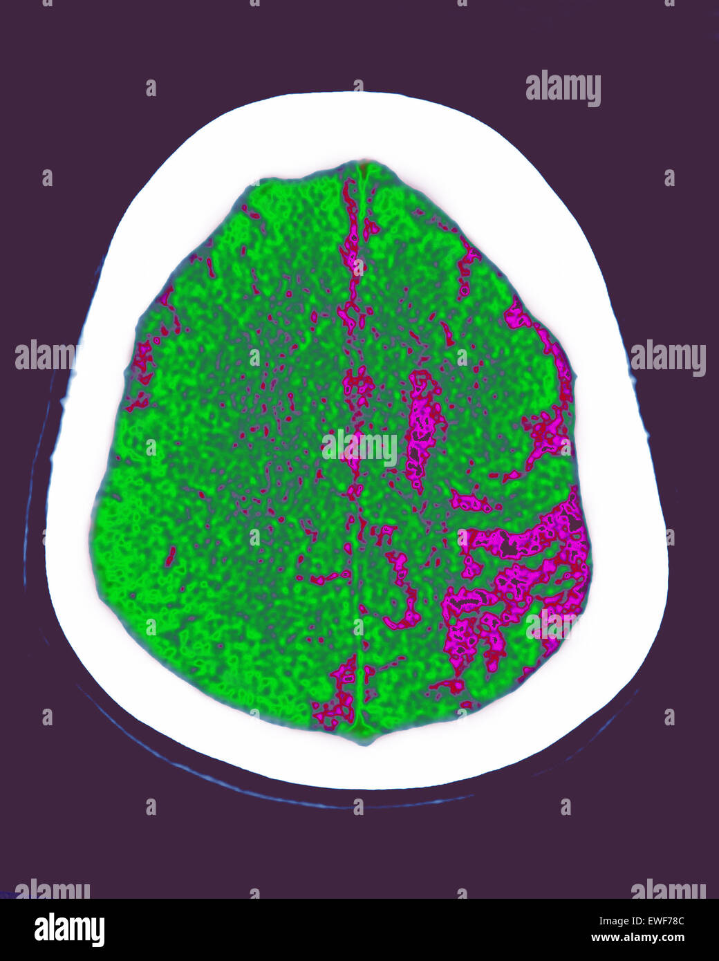 CEREBRAL ATROPHY, CT-SCAN Stock Photo