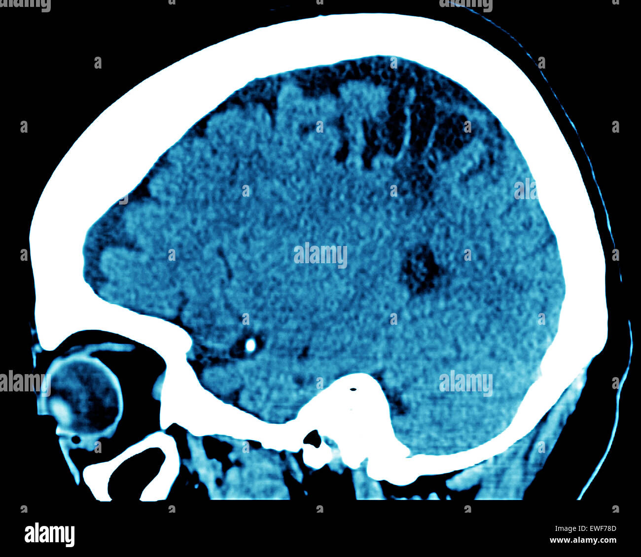 CEREBRAL ATROPHY, CT-SCAN Stock Photo