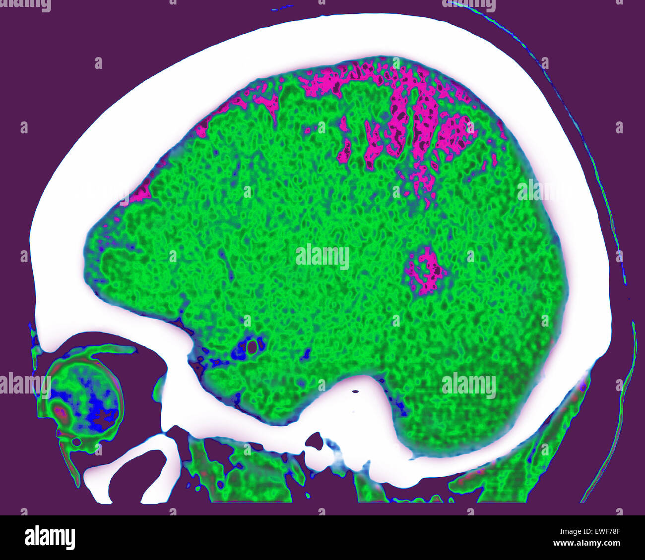 CEREBRAL ATROPHY, CT-SCAN Stock Photo