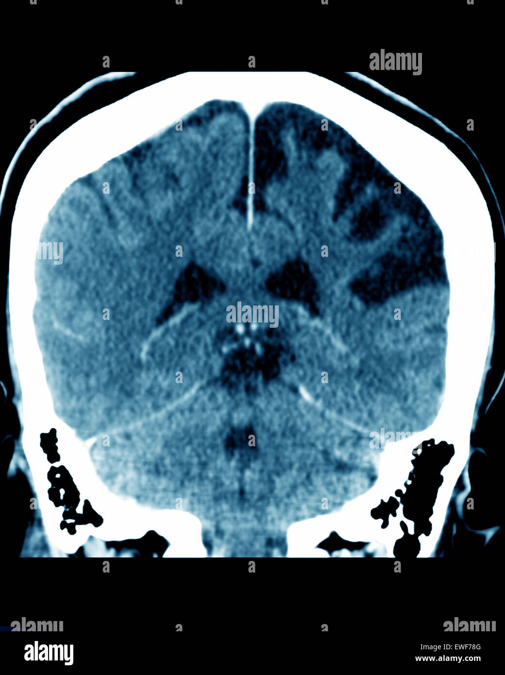 CEREBRAL ATROPHY, CT-SCAN Stock Photo