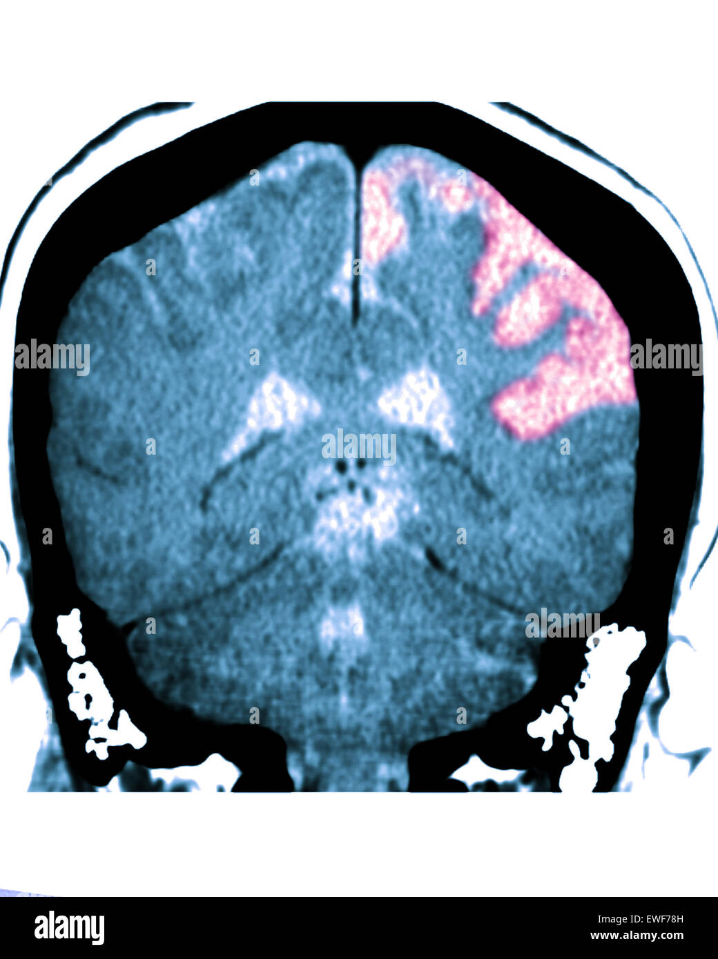 CEREBRAL ATROPHY, CT-SCAN Stock Photo