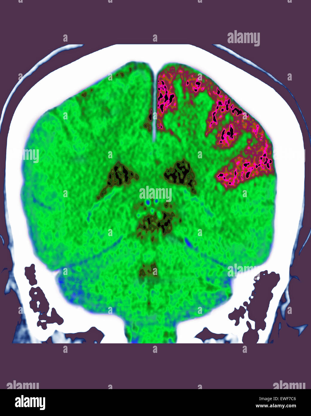 CEREBRAL ATROPHY, CT-SCAN Stock Photo