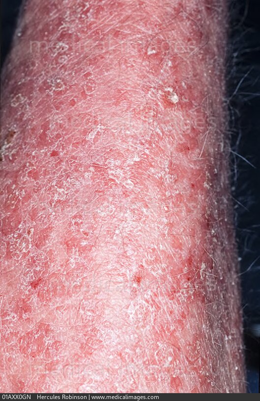 STOCK IMAGE, dermatology psoriasis very red and dry scaly patches with ...