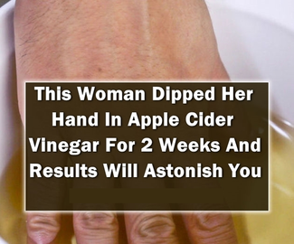 She Dipped Her Hand In Apple Cider Vinegar For 2 Weeks. When You Read You Will Do It Too!