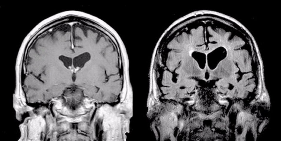 Parenchyma Brain