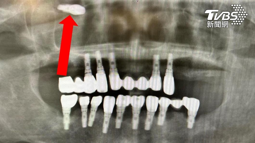 48歲男鼻子傳惡臭味 竟是植牙體＂掉入鼻腔＂併發鼻竇炎