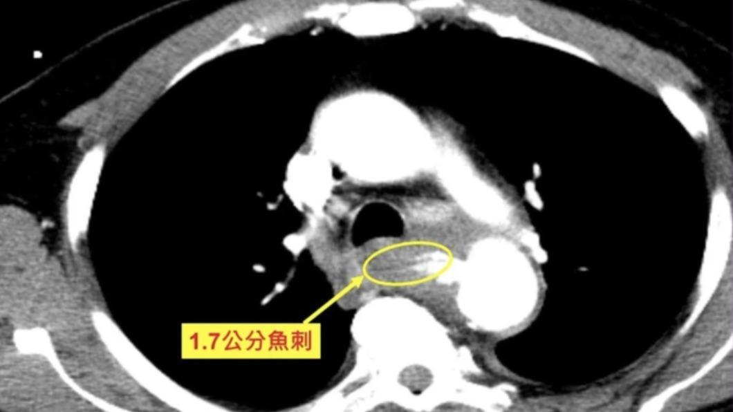 誤吞魚刺險喪命。（圖／醫院提供）