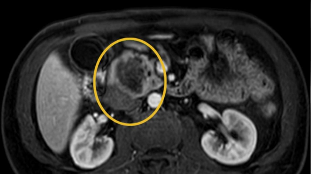 55歲婦人有長年抽菸史、飲食偏愛高油脂，健康檢查後發現罹患胰臟癌。（圖／翻攝自北投健康管理醫院）