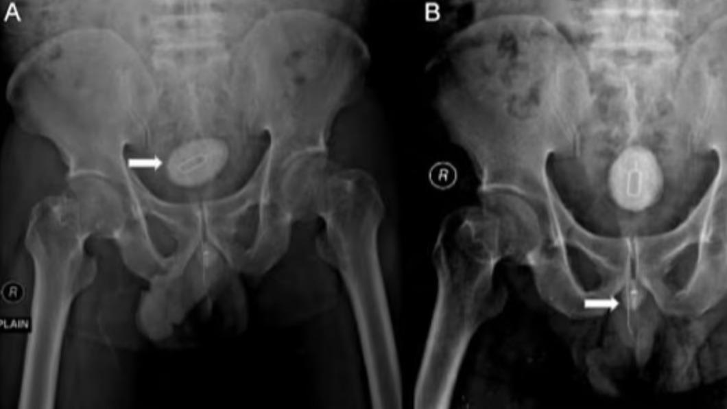 醫生在男子的X光檢查中發現了令人匪夷所思的「金屬物體」。（圖／翻攝自每日郵報）