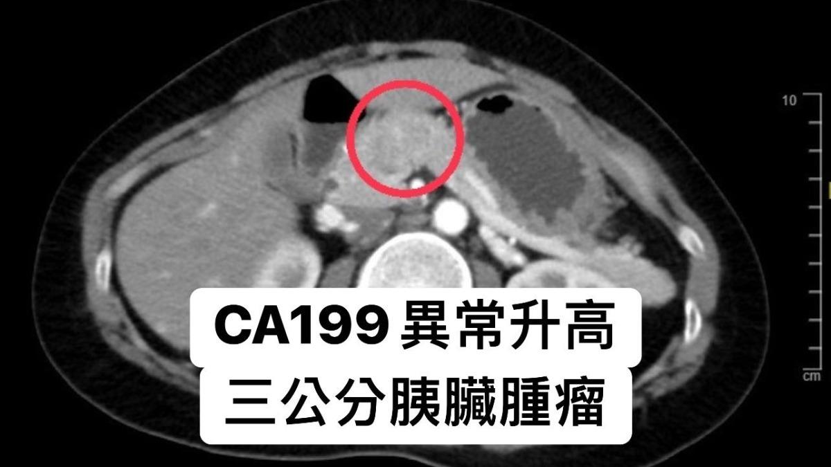 一名40歲女子不菸不酒，照斷層竟發現3公分胰臟腫瘤。（圖／翻攝自林相宏臉書）