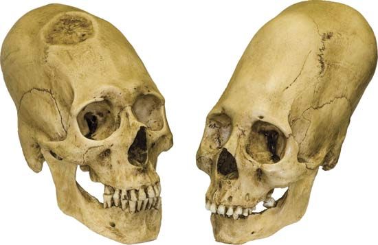 Peruvian elongated skulls, trephined male (left) and intact female (right), c. 1000 bc.