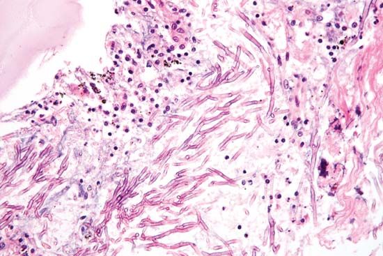 mycosis