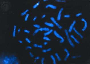 BRCA2 tumour suppressor gene on chromosome 13