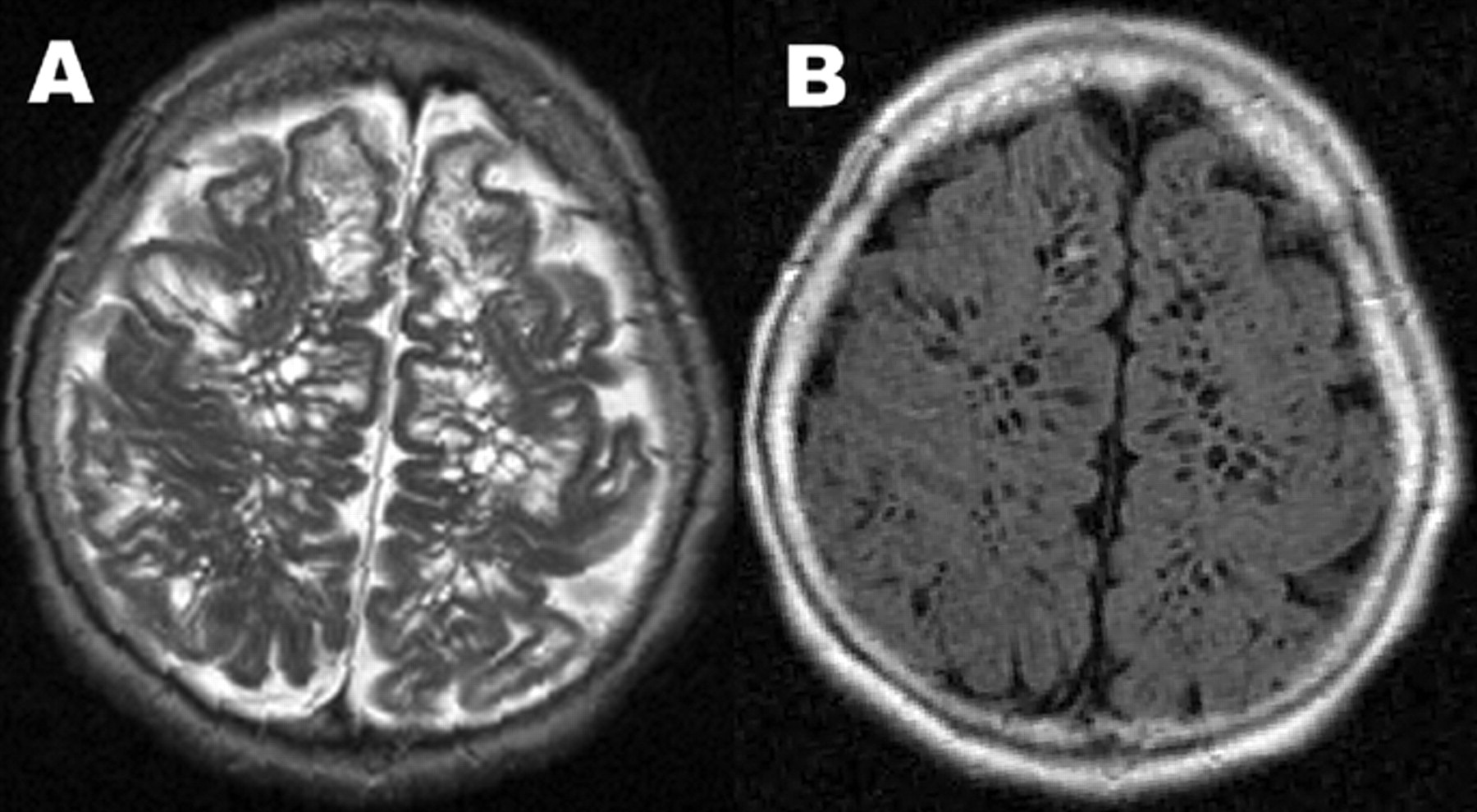 swiss cheese mri - A B