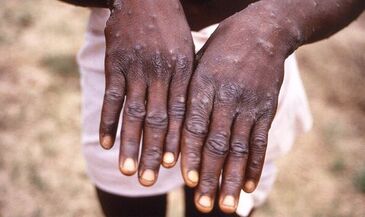 mpox cases uk