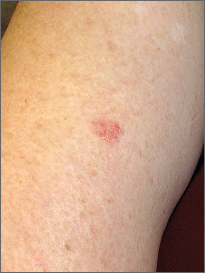 Rash on arm | MDedge Family Medicine