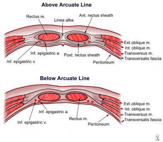 Rectus sheath hematoma