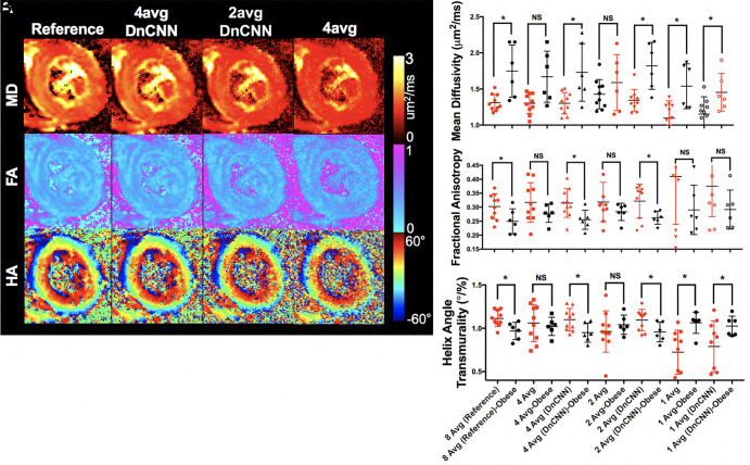 (A) Representative diffusion-tensor MRI (DT-MRI) parameter maps (mean diffusivity [MD], fractional anisotropy [FA], and helix angle [HA]) from a participant within the group with obesity comparing denoised (denoising convolutional neural network [DnCNN]) four- and two-average (avg) data with the reference eight-average data. The four-average data without denoising are shown to demonstrate an effect on the parameter quantification. (B) Significant differences are found for MD, FA, and HA transmurality between participants in the groups with and without obesity for reference eight-average data and DnCNN-denoised four- and two-average data. Conventional four-average data without the application of the DnCNN yield nonsignificant (NS) differences, which is also the case for two-average data without the application of the DnCNN. For one-average data without and with the application of the DnCNN, differences are conserved between groups with and without obesity for MD and HA transmurality but are not conserved for FA. * indicates statistical significance P < .05.