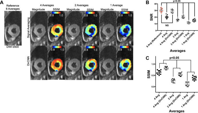 (A) Representative magnitude and structural similarity index (SSIM) masked images at four average(s) (Avg), two averages, and one average with and without the application of the denoising convolutional neural network (DnCNN) compared with the reference eight-average diffusion-weighted b = 500 image. Note that magnitude images were windowed to better visualize the underlying spatial pattern of noise (40% increased brightness and 20% decreased contrast). (B) The signal-to-noise ratio (SNR) is not different between four-average DnCNN data and the reference eight-average data (29.1 ± 2.7 vs 30.5 ± 2.9, respectively; P = .37). SNR is different for all other comparisons (P < .001). (C) SSIM is higher after DnCNN is applied for four- two-, and one-average data (P < .001).