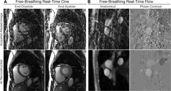 Artificial intelligence (AI)–based image reconstruction. Free-breathing electrocardiogram-free real-time cardiac MRI scans collected with highly accelerated imaging sequences have substantial aliasing artifacts. Convolutional U-Net models are trained using paired high-quality and aliased images to remove such artifacts. (A) A single U-Net model can remove artifacts from balanced steady-state free precession real-time cine images, as shown in these diastolic and systolic cardiac phase MRI scans in the short-axis plane. (B) Gradient-recalled echo real-time phase-contrast flow imaging acquires velocity-compensated and velocity-encoded images, as shown in these aortic outflow tract plane MRI scans. Two separate U-Net models were used to remove the artifacts while preserving the phase-contrast information.