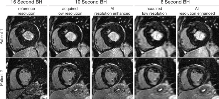 Artificial intelligence (AI)–based resolution enhancement. A pretrained AI-based resolution enhancement model based on balanced steady-state free precession cardiac MRI cine data can be used to accelerate inversion recovery late gadolinium enhancement imaging, as shown in images in the short-axis plane. For instance, current existing sequences require a 16-second breath hold (BH) for imaging, with one breath hold for each section. The imaging time can be reduced to 10 seconds or even 6 seconds at the expense of diminished spatial resolution. The AI model is used to enhance the spatial resolution in images with shorter imaging time.