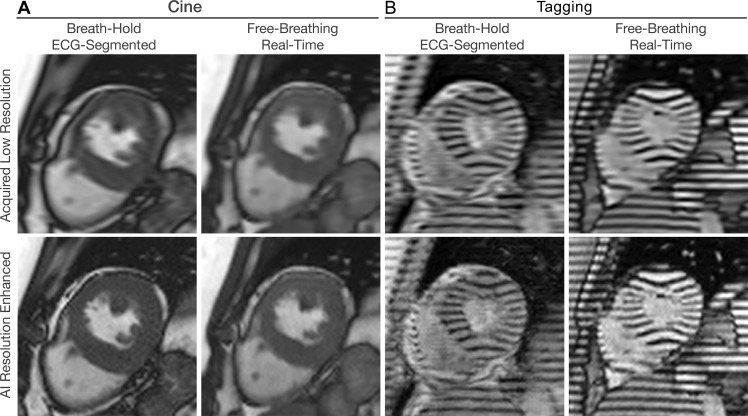 Artificial intelligence (AI)–based resolution enhancement. Collecting balanced steady-state free precession cardiac MRI scans with lower resolution reduces scan time since fewer data are acquired. Acceleration reduces the breath-hold time needed in breath-hold electrocardiogram (ECG)–gated sequences or enables free-breathing real-time imaging with high temporal resolution. (A) Cine images in the short-axis plane show enhancement of spatial resolution using a generative adversarial network. (B) Tagging images in the short-axis plane show enhancement of spatial resolution using a pretrained model based on cine images.