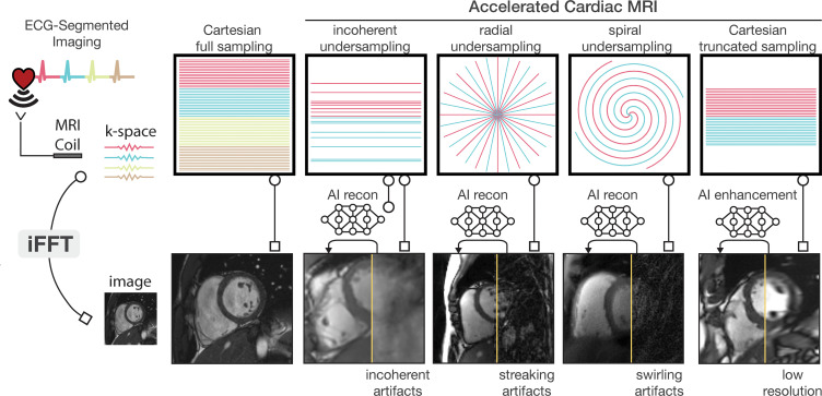 Diagram of artificial intelligence (AI)–based image reconstruction (recon) and enhancement. The sampling trajectory dictates the k-space data collection path; a Cartesian trajectory is a grid-like path. Reconstruction latency is the delay from data collection to viewing the image. K-space data are collected over multiple heartbeats via electrocardiogram (ECG)–segmented imaging, usually using a fully sampled Cartesian trajectory, which aids in functional imaging and minimizes motion artifacts at the cost of longer scan time. Accelerated imaging, employing undersampled Cartesian, radial, or spiral sampling, reduces scan time by acquiring partial k-space data. However, utilizing a simple inverse fast Fourier transform (iFFT) for frequency (ie, k-space)–to-image domain conversion causes artifacts like incoherence, streaking, and swirling in images. Various AI reconstruction models mitigate these artifacts, improving image clarity and quality. Another method to reduce scan time is truncating the k-space data, which yields lower-resolution images without aliasing artifacts. AI enhancement is used in this context to restore the lost spatial resolution.